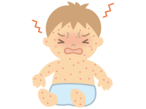 非公開: 乳児湿疹？アトピー？ステロイドをやめた長男の場合 ２歳で治りました！